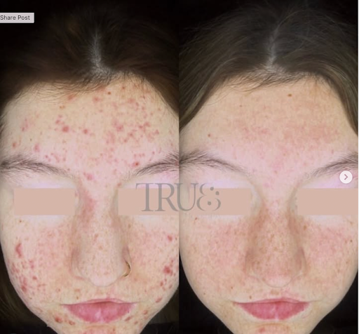 Best Facial for Acne in Twickenham: Expert Advice from a Trusted Skin Clinic