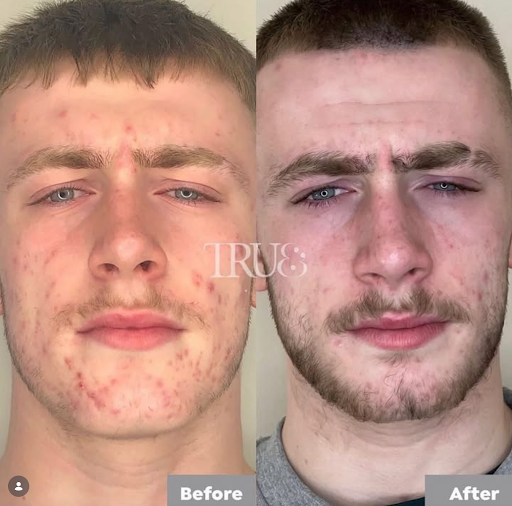 Why We are a Leading Skin Care Clinic for Acne and Facial Rejuvenation Treatments Twickenham