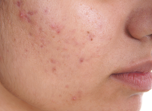 From Marks to Smooth Skin: Best Treatment for Acne Scars Twickenham From Marks to Smooth Skin: Best Treatment for Acne Scars Twickenham