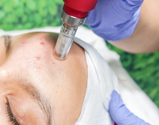 Dermapen Microneedling in Benefits Twickenham: Expert Treatment for Best Results Dermapen Microneedling in Benefits Twickenham: Expert Treatment for Best Results