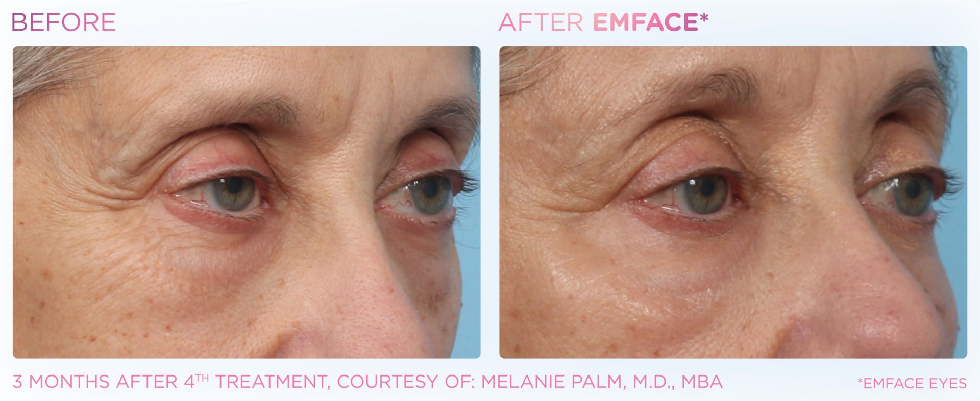 Emface PIC Ba card female eyes 178 ENUS100 Emface PIC Ba card female eyes 178 ENUS100