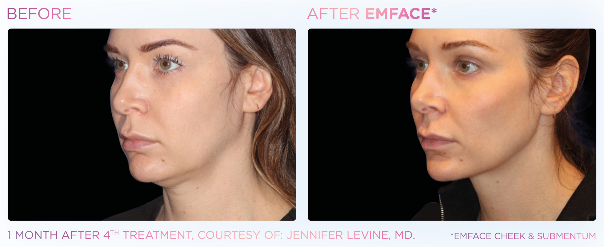 Emface PIC Ba card female submentum 124 ENUS100.3 Emface PIC Ba card female submentum 124 ENUS100.3