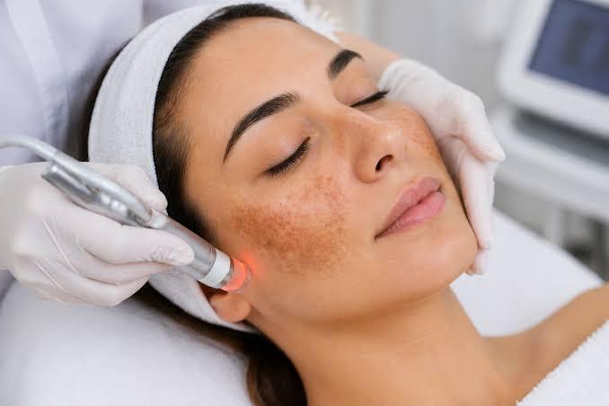 Melasma
