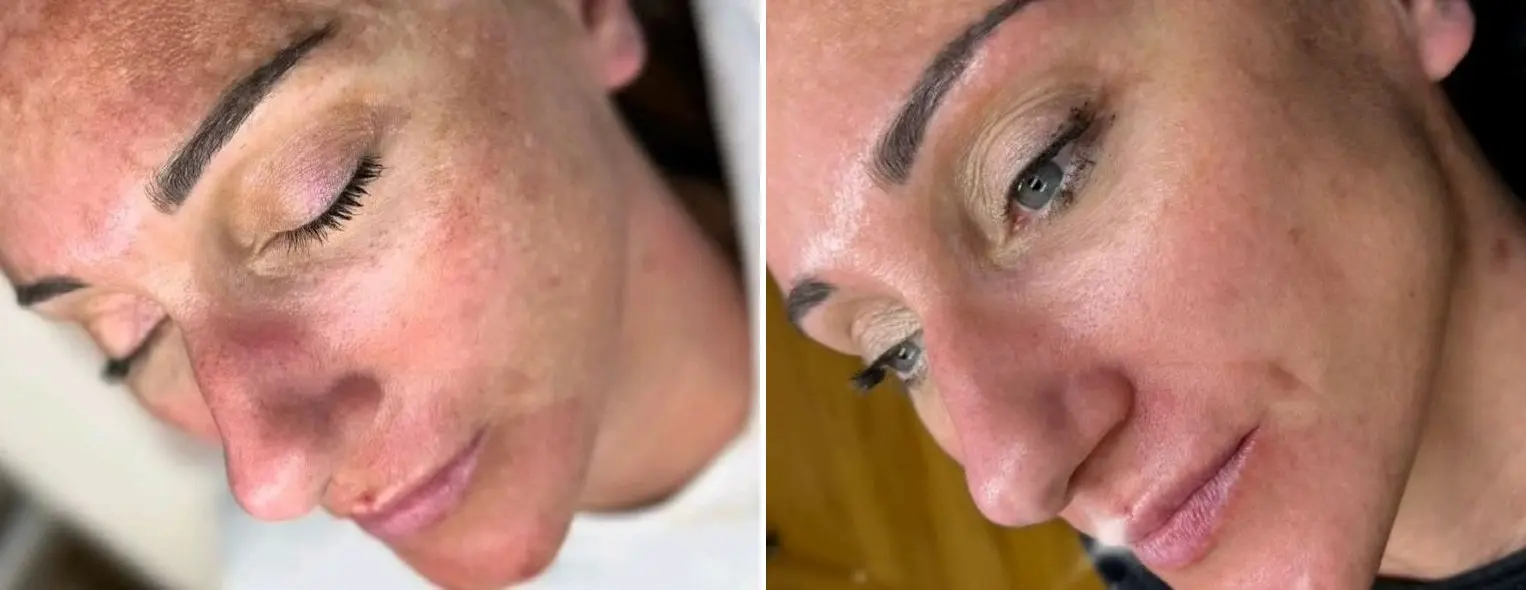 carboxytherapy hero carboxytherapy hero